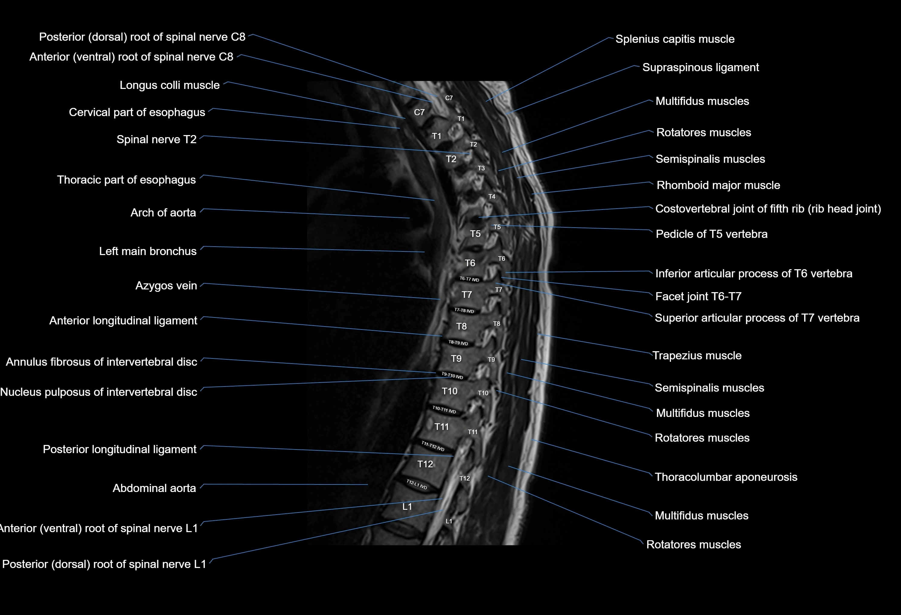 MRI thoracic spine sagittal  cross sectional anatomy 3T radiology  image-img-00001-00017.webp